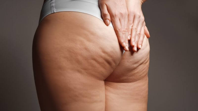 Cellulite